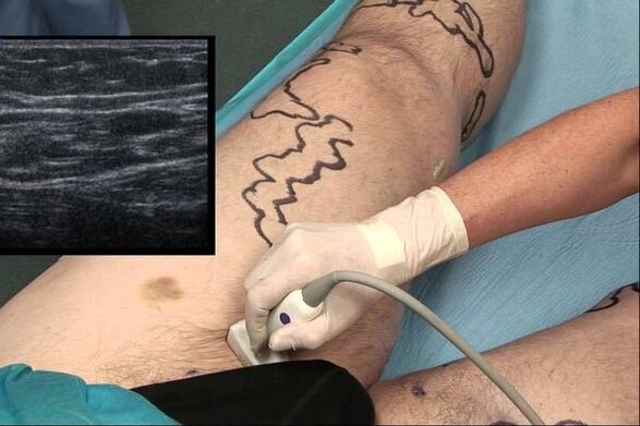 diagnostika křečových žil u mužů