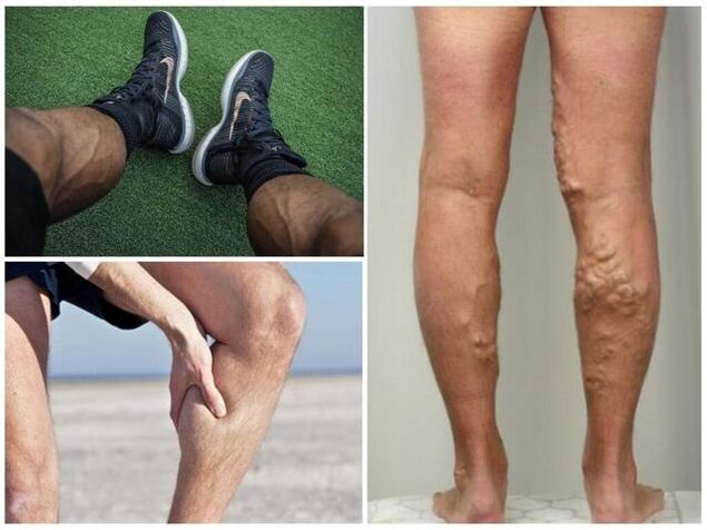 jak vypadají křečové žíly na mužských nohách