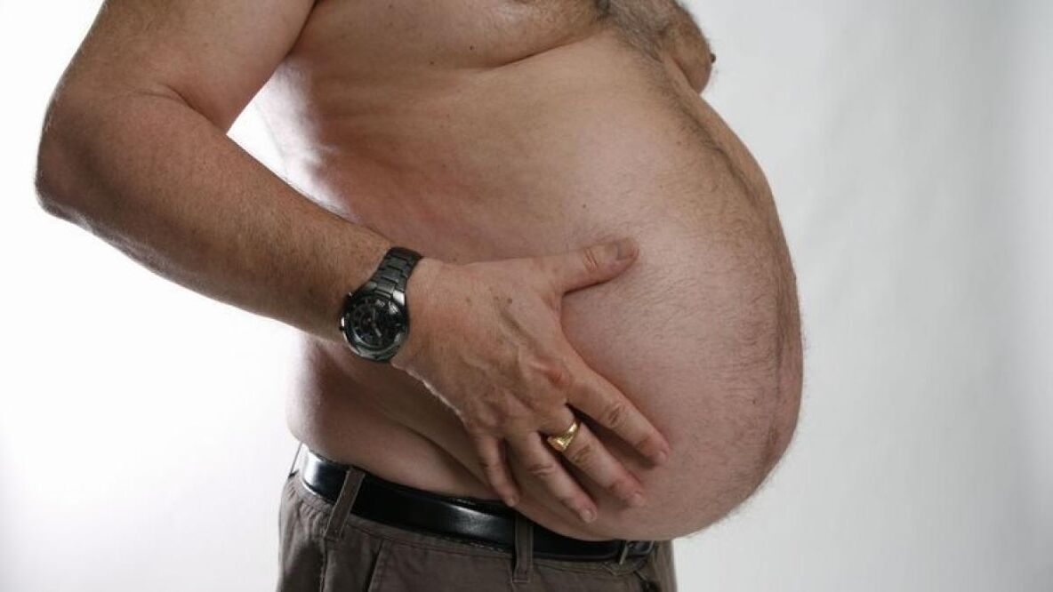 obezita jako příčina rozvoje křečových žil