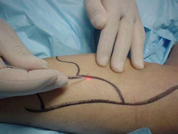 laserová léčba křečových žil
