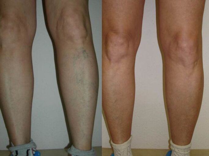nohy před a po laserovém ošetření křečových žil